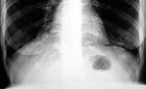 Mild Cylindrical Bronchiectasis Comprehensive Guide To Treatment