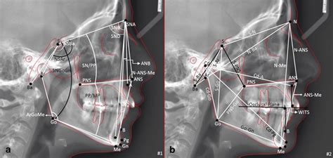 A Skeletal Angular Measurements 1 Sna 2 Snb 3 Anb 4 Snd Download Scientific