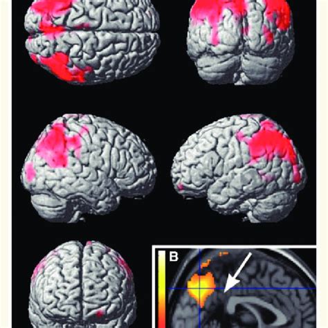 Regional Cerebral Blood Flow In The Group With Both Parkinson And