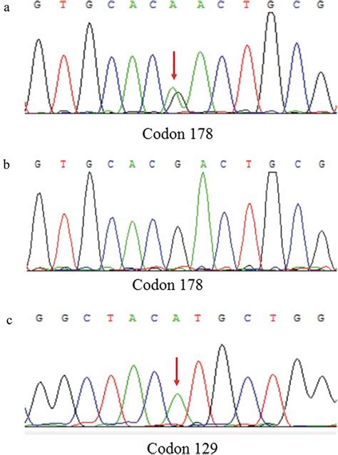 Dna Sequence At Codon 178 Of Prnp Gene From The Patient A And A