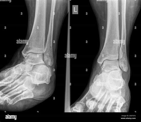 Fracture Of Tibia And Fibula Stockfotos Und Bilder Kaufen Alamy