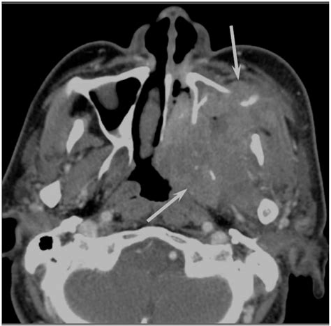 Jcm Free Full Text Imaging Characteristics Of Malignant Sinonasal Tumors