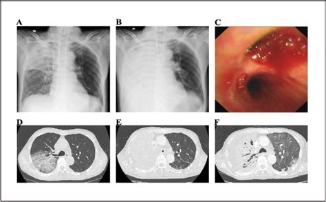 Radiographic And Bronchoscopic Findings A Chest Xray At The