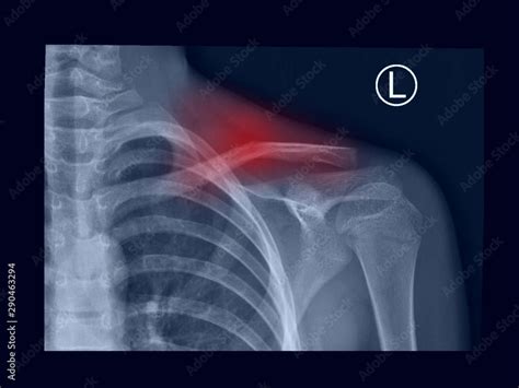 Film X Ray Shoulder Radiograph Show Fracture Clavicle Collar Bone