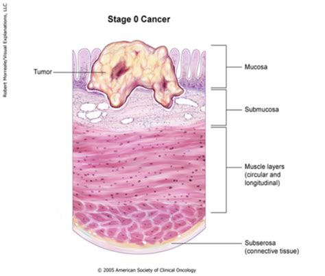 Oncology Colorectal Cancer Pathology Types Treatment Screening