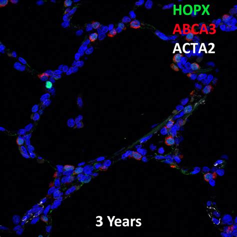 Year Human Lung Hopx Abca And Acta Confocal Imaging