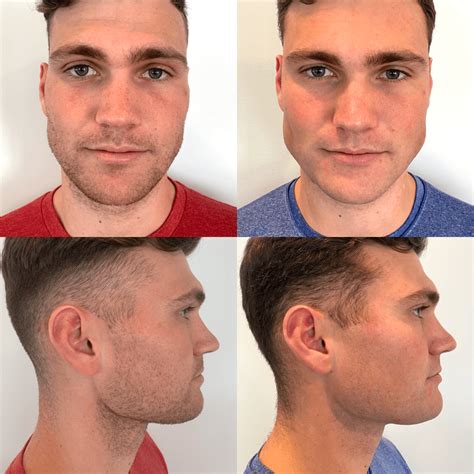 Jawline Exercises Before And After 100 Genuine Ids Deutschlandde