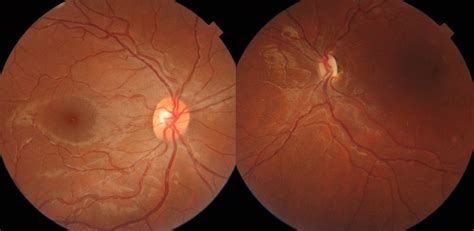 A Guide to Optic Disc Abnormalities with Cheat Sheet