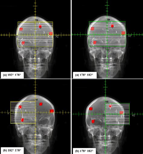 Figure 1 From Comparison With Conventional Arc And Split Partial Arc Techniques Of Volumetric