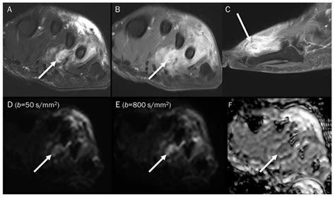 Diagnostics Free Full Text Pitfalls Of Diffusion Weighted Imaging