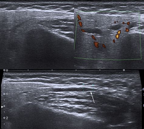 Routine And Advanced Ultrasound Of Major Salivary Glands Neuroimaging