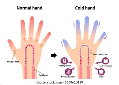 Cold Hand Blood Circulation Illustration Sensitivity Stock Vector