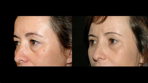 Produktiv Botanik Konstruktion Bolsa Nos Olhos Cirurgia Antes E Depois