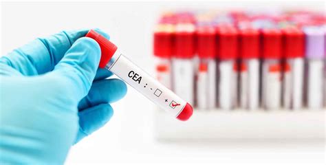 CEA test, carcinoembryonic antigen test, uses & interpretation