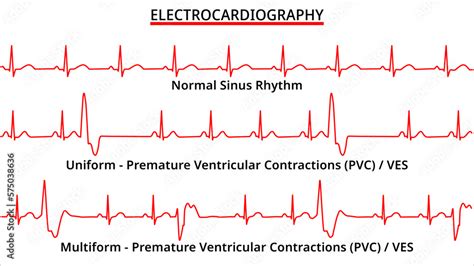 Set Of ECG Common Abnormalities Normal Sinus Rhythm Uniform And