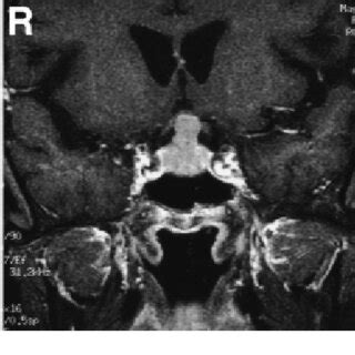 Left Sagittal T Weighted Magnetic Resonance Mr Image Showing An