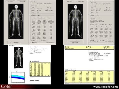 Densitométrie osseuse du corps entier DXA absorptiométrie