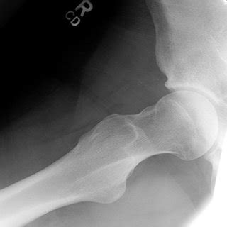 Postoperative Frog Leg Radiograph Of The Right Hip Demonstrating