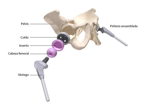Tipos de prótesis de cadera lluispuigverdie es cirugía ortopédica