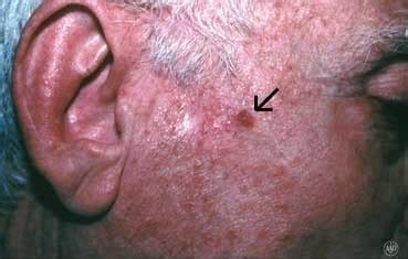 Squamous Cell Carcinoma - Dawes Fretzin Dermatology Group