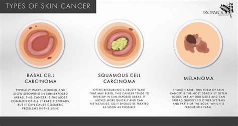 Appearance Of Skin Cancer Types