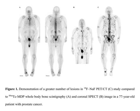 A Prospective Multicenter Intra Individual Comparison Of F Naf Pet Ct