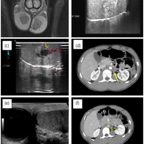 Perioperative And Intraoperative Imaging Bilateral Testicular Masses