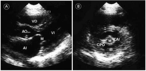 Valoración anatómica de la estenosis mitral