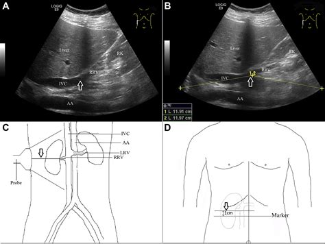 New Method For Ultrasound Guided Inferior Vena Cava Filter Placement