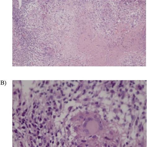 Endocervical Pathology Revealed Endocervicitis Due To Tuberculosis