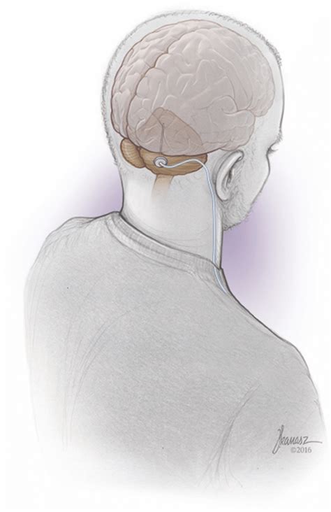 Deep Brain Stimulation Of The Human Cerebellum Cartoon Drawing