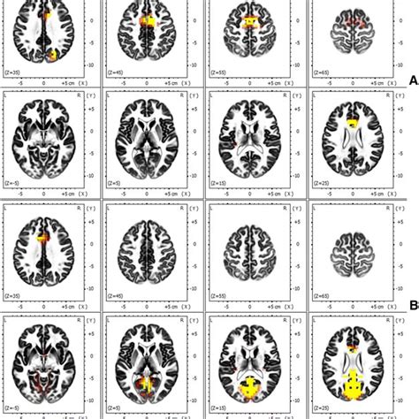 Differences in cortical activity between actual and imagined reaching ...