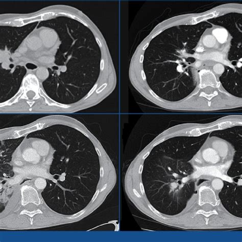 (PDF) Diagnosis and treatment of radiation pneumonitis