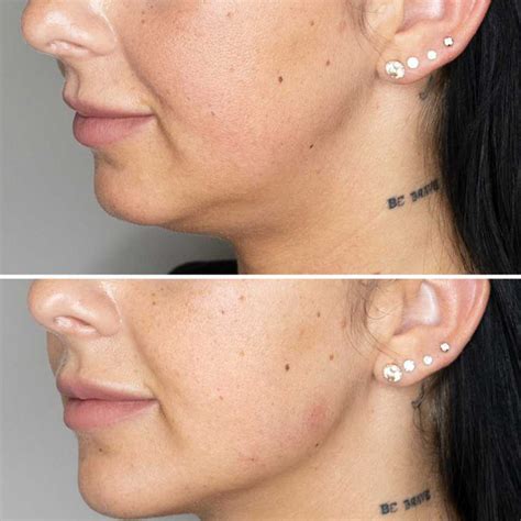 Jawline Filler Before And After Filler Aesthetic