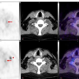 Top Panel 68 Ga PSMA 11 Axial PET Axial CT And Axial Fused PET CT