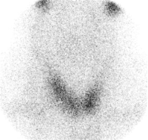 Thyroid Scintigraphy Showing Irregular Uptake Throughout The Thyroid