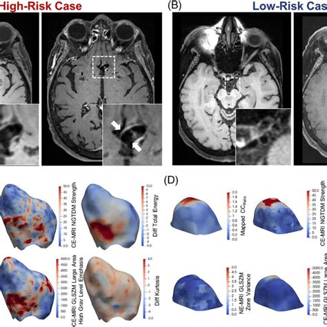 Visualization Of Local Radiomics In High And Low Risk Intracranial