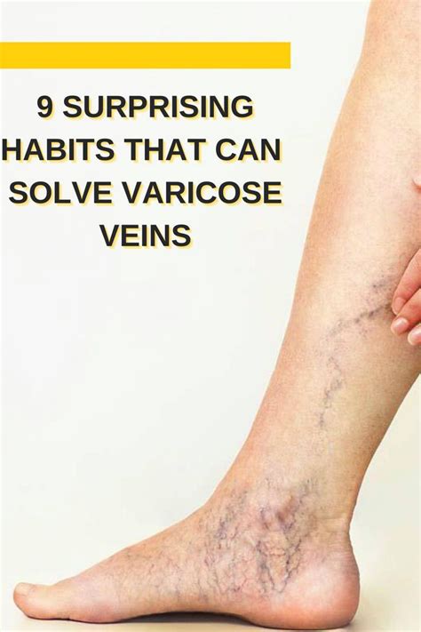 How To Get Rid Of Varicose Veins 5 Natural Remedies Varicose Veins