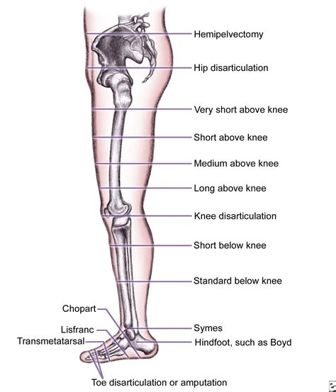 MEdICaL InFO: Lower Limb Amputation