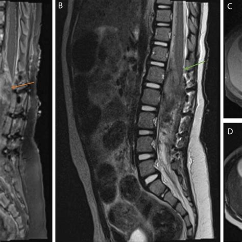 Pre Operative Mri Of The Spine Sagittal T1 Post Gadolinium Contrast