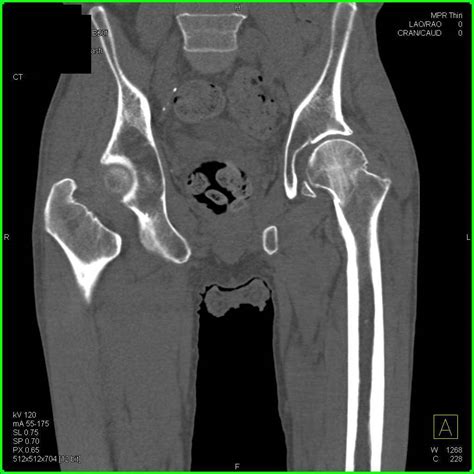 Left femoral neck fracture - litoclicks