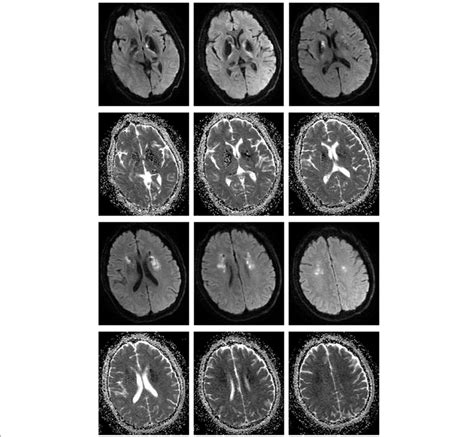 Brain Magnetic Resonance Imaging Mri Hyperintense Signal In