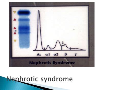 Ppt Serum Protein Electrophoresis Powerpoint Presentation Free