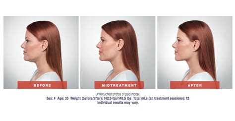 Kybella Double Chin Treatment Radiance Skincare Laser Medspa