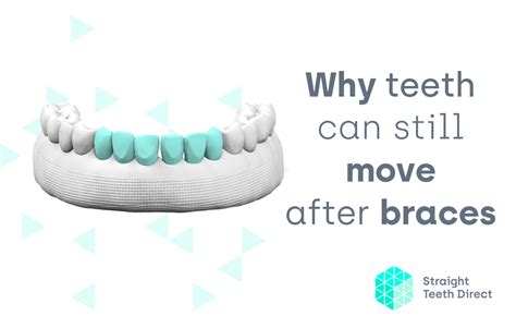 Why Teeth Move Even After Having Braces & How To Realign Them