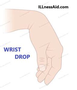 Wrist Drop: Causes, Symptoms, Exercises and More - ILLnessAid