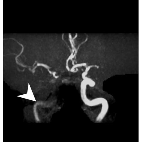 A Year Old Male Presented With Acute Onset Left Sided Weakness And