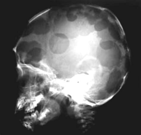 Langerhans Cell Histiocytosis