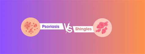 Shingles Vs Psoriasis Distinguishing These Skin Conditions