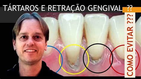 Tenho Retração Gengival e Tártaro Nos Dentes Técnica Ninja 2 0 Para